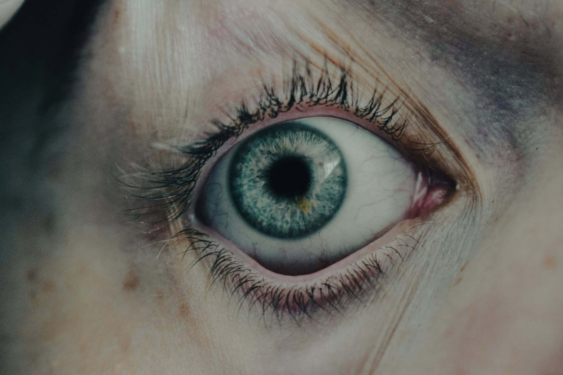 Amniotic Membranes 101: The Role of Amniotic Membranes in Treating Severe Dry Eye